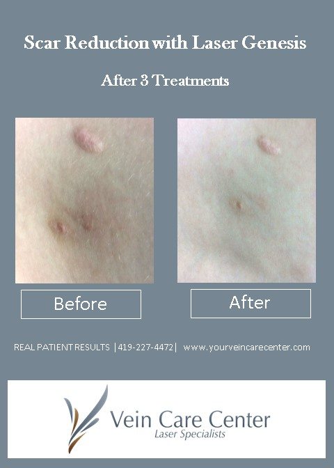 Laser Scar Removal Before &amp; After Pictures Lima, Auglaize ...