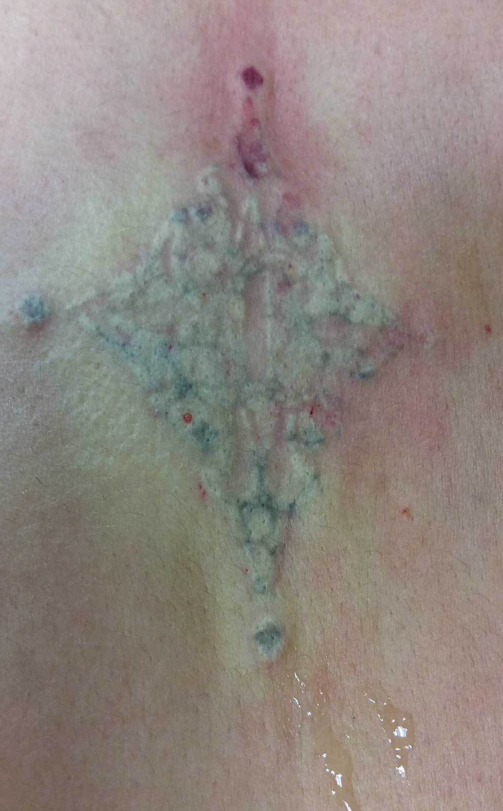 tattoo removal before amp after pictures lima auglaize tattoo removal before amp after pictures lima auglaize