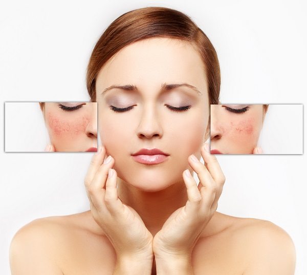 scar-removal