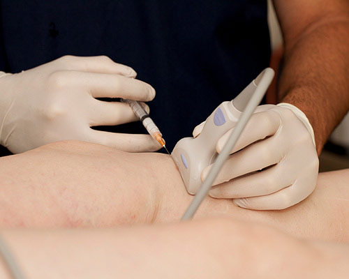 Echosclerotherapy