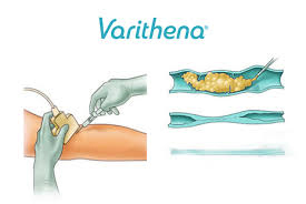 varithena visual