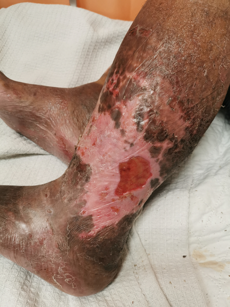 Chronic Venous Insufficiency Lima, OH