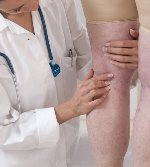 sclerotherapy patient