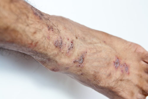 venous stasis dermatitis patient