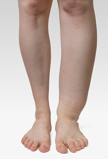 Lymphedema Ohio | Leg Swelling Lima, OH | Celina