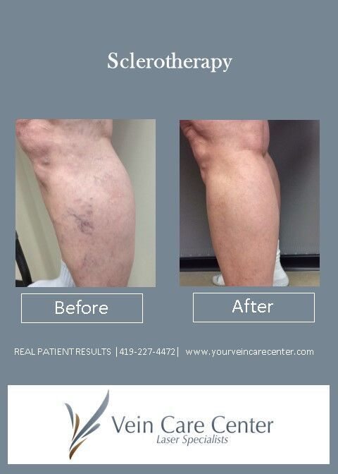 what is sclerotherapy