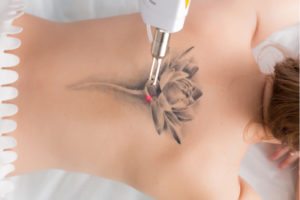 laser tattoo removal patient