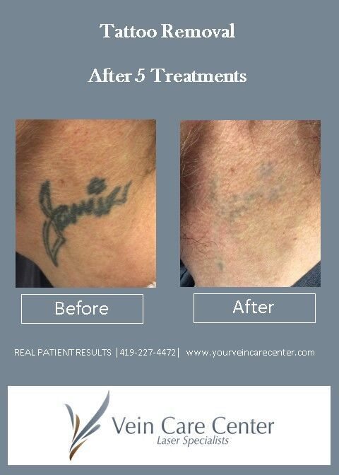 How Effective is Laser Tattoo Removal? | Laser Specialists
