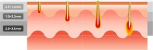 Microneedling graphic