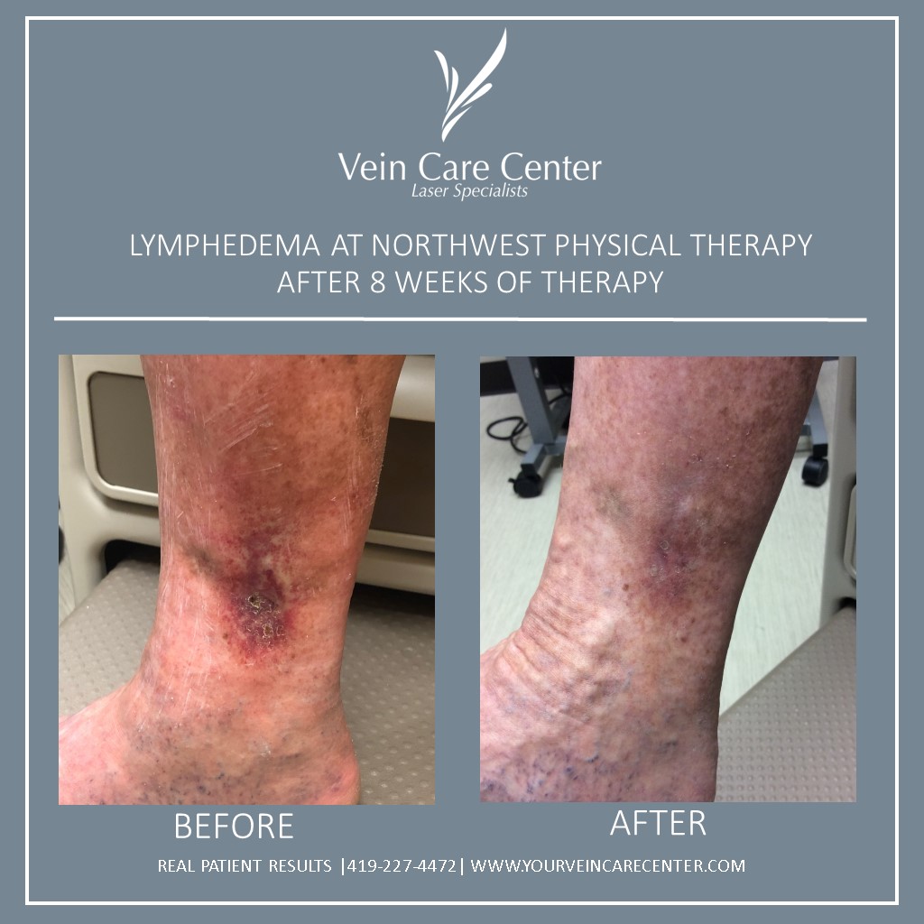 Lymphedema Therapy Before And After Lima Ohio Vein Care Center