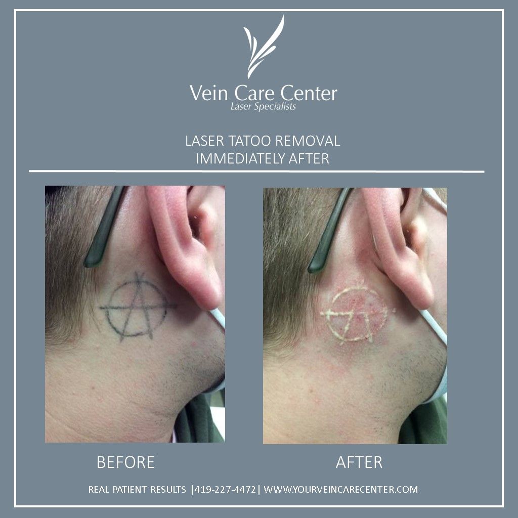 Tattoo Removal Before & After Lima, OH | Vein Care Center