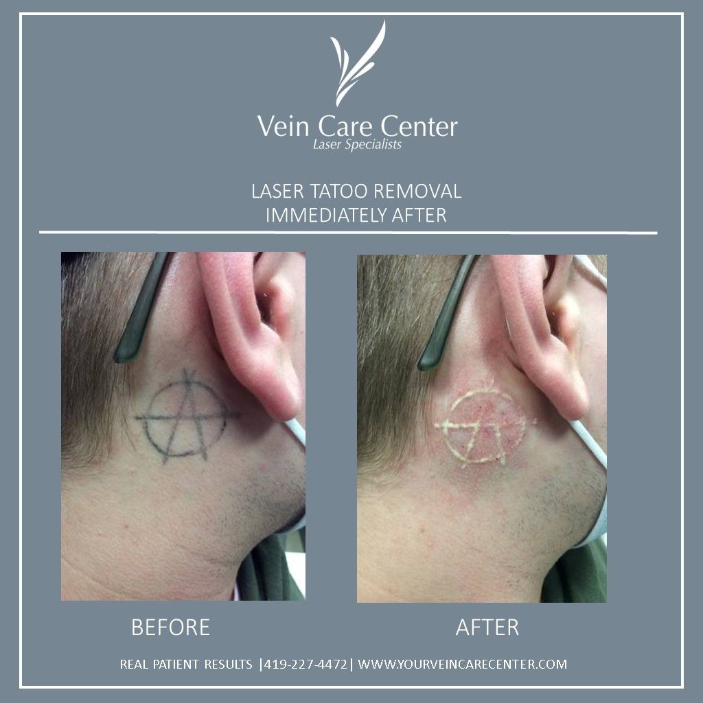 Tattoo Removal Before & After Lima, OH | Vein Care Center Tattoo Removal Before & After Lima, OH | Vein Care Center