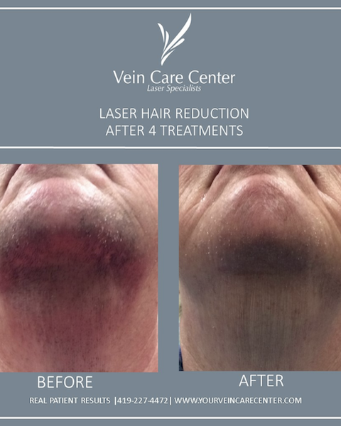 laser hair reduction before and after