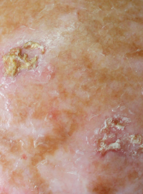 Actinic Keratosis patient