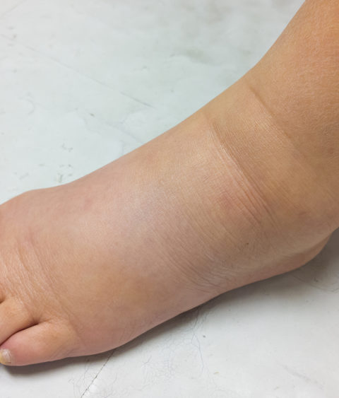 lymphedema patient