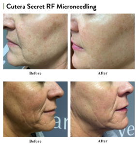 Microneedling Before and After